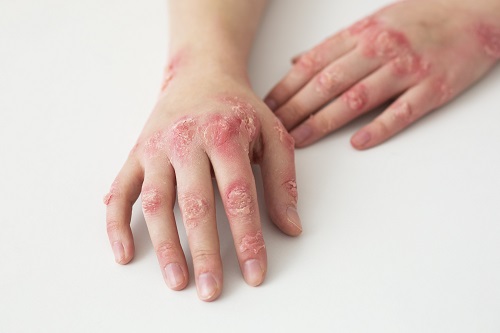 How to Recognize the Symptoms of a Popped Blood Vessel in Your Hand?