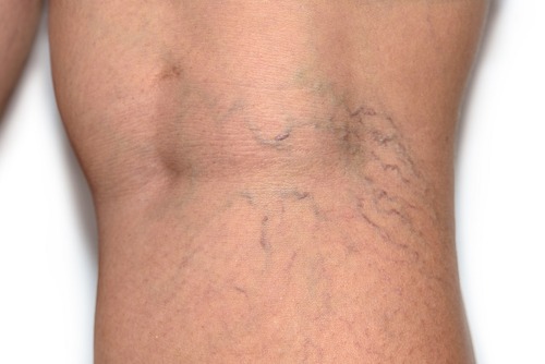 Are Varicose Veins More Than Just a Cosmetic Concern