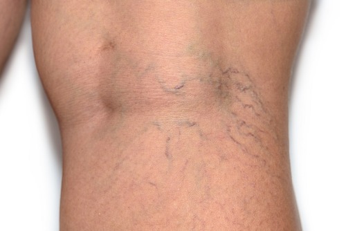 Are Varicose Veins More Than Just a Cosmetic Concern?