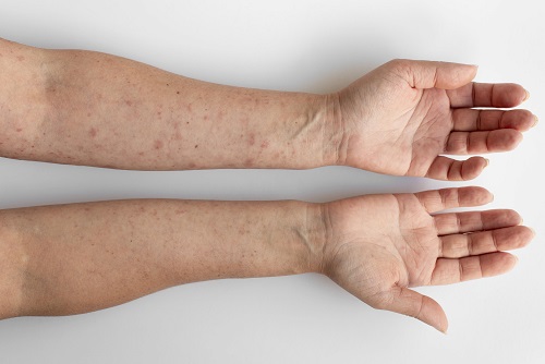 What Do Dark Veins on Your Hands Say About Your Health