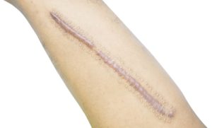 Laser Scar Removal: Guide for Diverse Skin Types