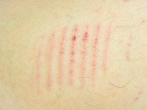 Laser Treatment for Scars: What You Should Know about it?