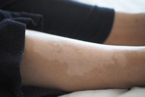Laser Scar Removal for Dark Skin Tones