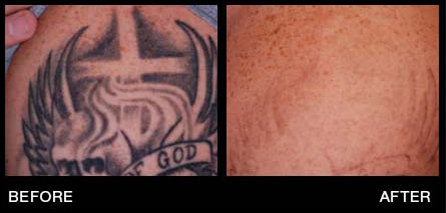 Tattoo Removal in Miami Florida by Fox Vein and Laser Experts.