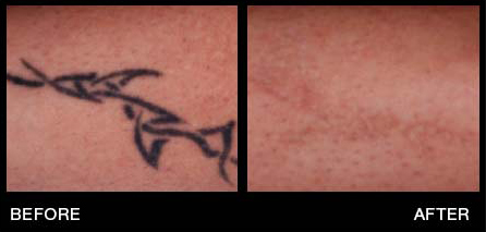 Tattoo Removal in Miami Florida by Fox Vein and Laser Experts.