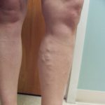 Testimonials of Fox Vein and Laser Experts in Miami, Florida.