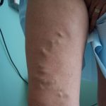 Testimonials of Fox Vein and Laser Experts in Miami, Florida.