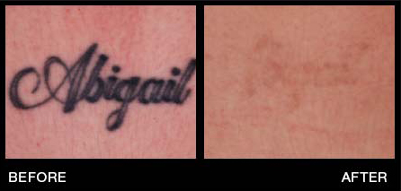 Tattoo Removal in Miami Florida by Fox Vein and Laser Experts.