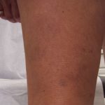 Testimonials of Fox Vein and Laser Experts in Miami, Florida.