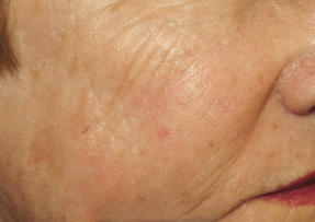 Skin Rejuvenation in Miami Florida by Fox Vein and Laser Experts.