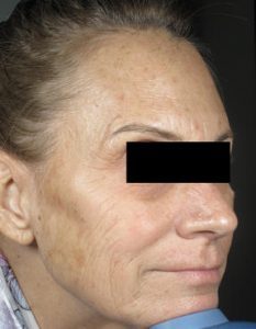 Skin Rejuvenation in Miami Florida by Fox Vein and Laser Experts.