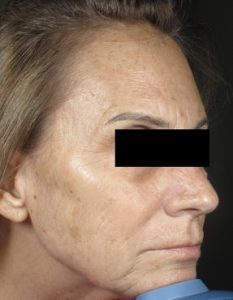 Skin Rejuvenation in Miami Florida by Fox Vein and Laser Experts.