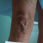 Testimonials of Fox Vein and Laser Experts in Miami, Florida.