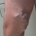 Testimonials of Fox Vein and Laser Experts in Miami, Florida.